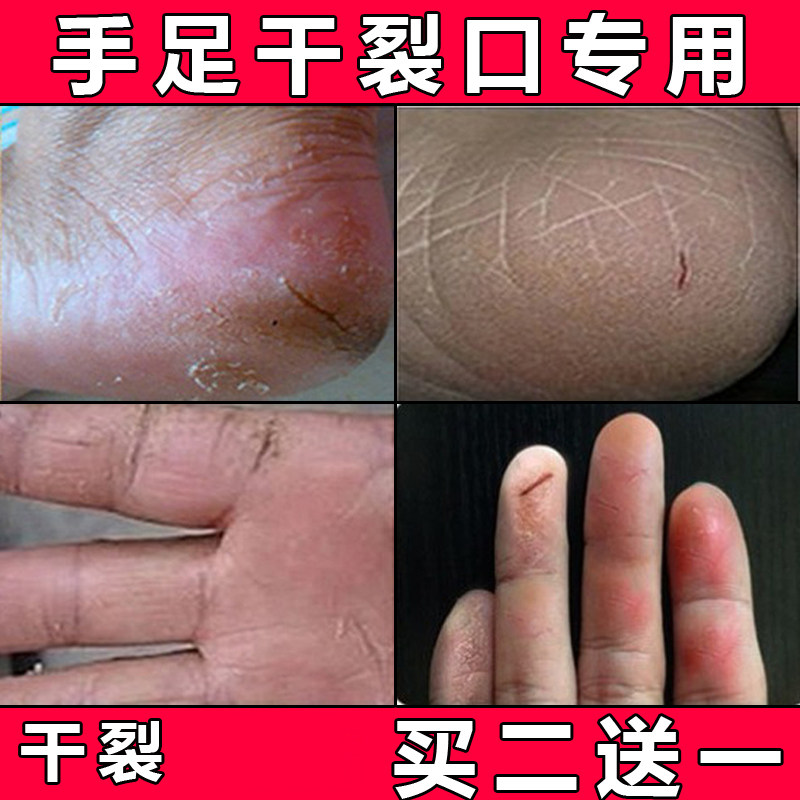 脚跟龟裂脚后跟干裂皲裂干燥脱皮防裂膏手裂脚裂口手足开裂皴裂霜