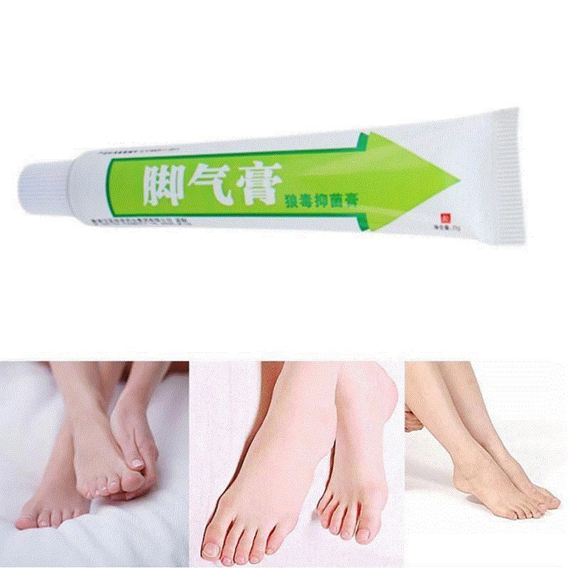 Skin Itching Antifungal Cream For Corticosteroid Body Tinea