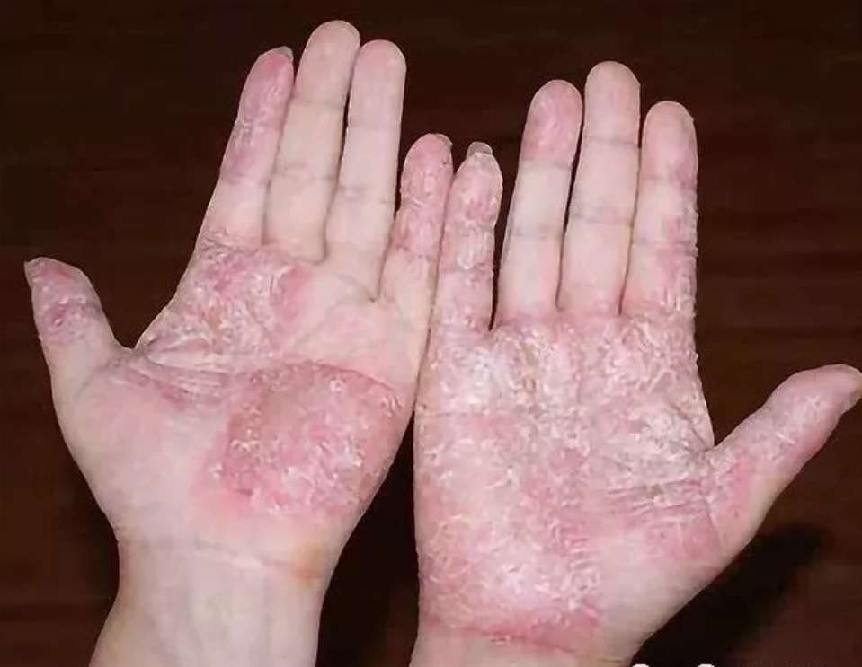 手干燥冬天粗糙防裂脱皮修复