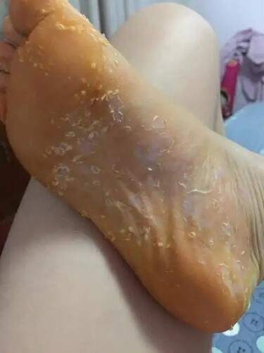 手脱皮季节性修复霜手掌手指头蜕皮开裂干裂起皮掉皮脚爆皮男用手