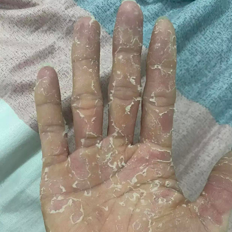 儿童小孩手指头上蜕皮手脱皮严重专用膏干燥起皮掉皮手足爆皮干裂