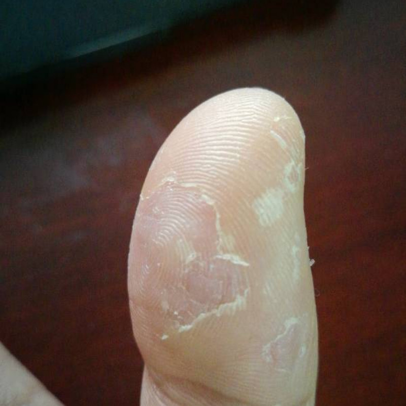 手脱皮严重脱皮专用手指干裂掉皮手掌褪蜕皮手上起皮干燥季节性