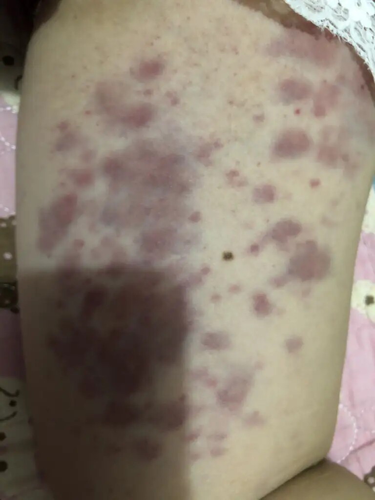 春夏天腿痒小腿皮肤干燥湿过敏发痒换季腿上起小红点疙瘩外用乳膏