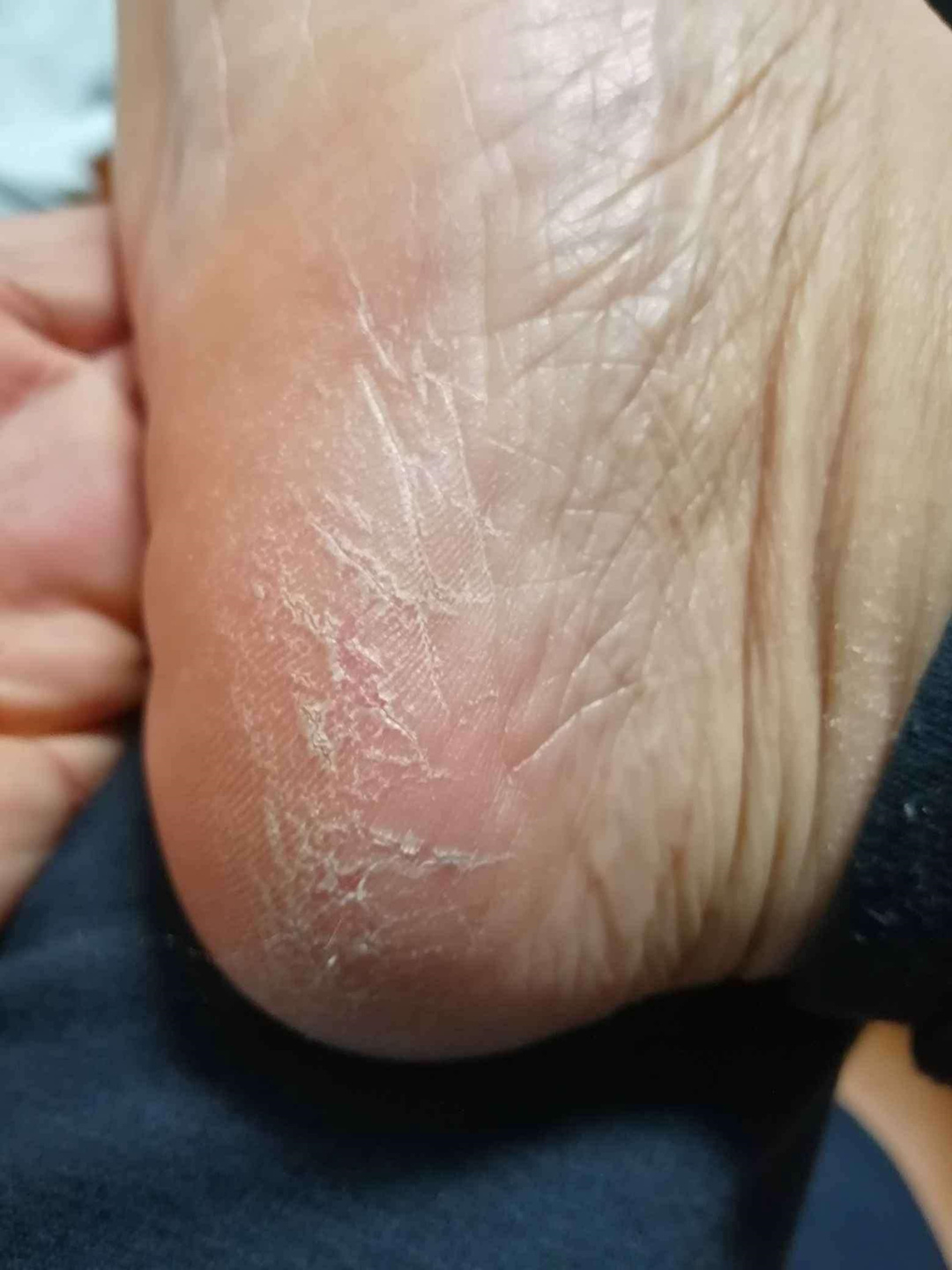 脚面痒脚背痒夏天热出汗越抓越痒脚上皮肤干燥痒止痒抑菌清洁软膏