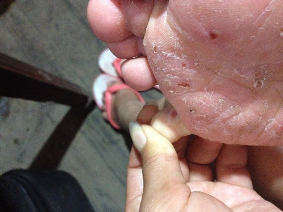 脚趾头脱皮干裂杀菌水泡止痒