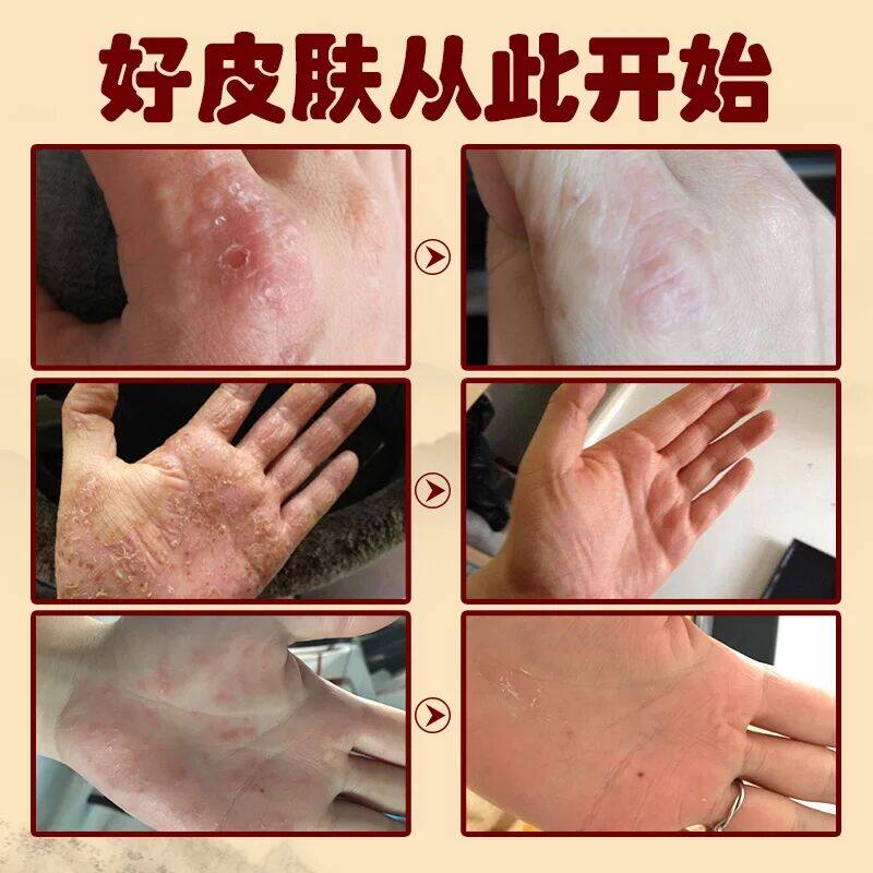 猜你喜欢推荐 草本膏 39元一盒,78元发3盒,皮肤好了真开心