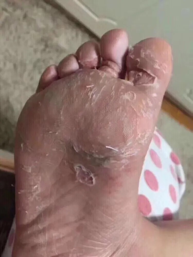 烂手丫手指头手丫丫手脚脱皮干裂手脱皮脚底皮肤足部手气痒水泡