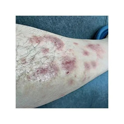 屁股痒鸡去皮肤毛囊角质全身鱼鳞肤去腿上手臂背部胳膊小红点疙瘩