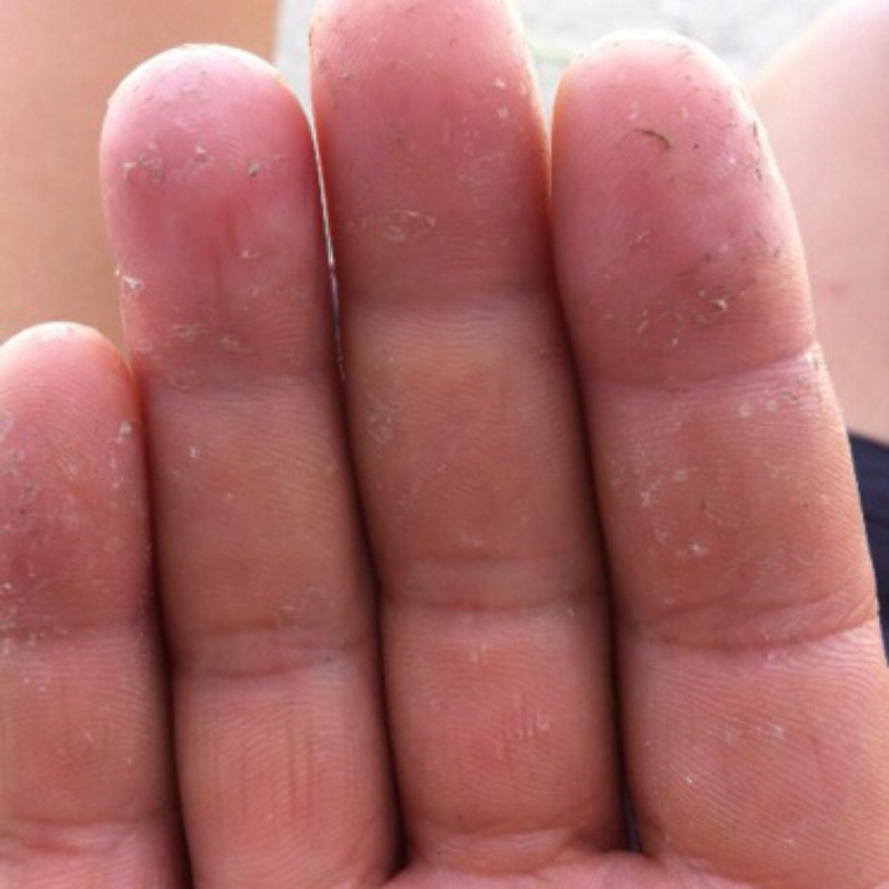 24手上起皮干燥脱皮手掉皮膏干裂手掌手心儿童手指头蜕皮脚底开裂