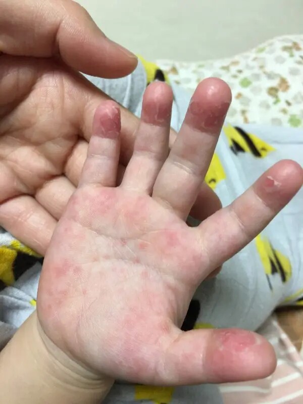 手足脱皮膏手指上起皮干燥爆皮儿童手掌蜕皮手心手脚掉皮褪头专用