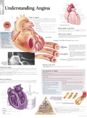 预订Understanding Angina Laminated Poster[9781930633230]