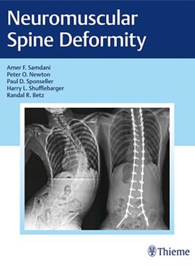 预订不退不换Neuromuscular Spine Deformity