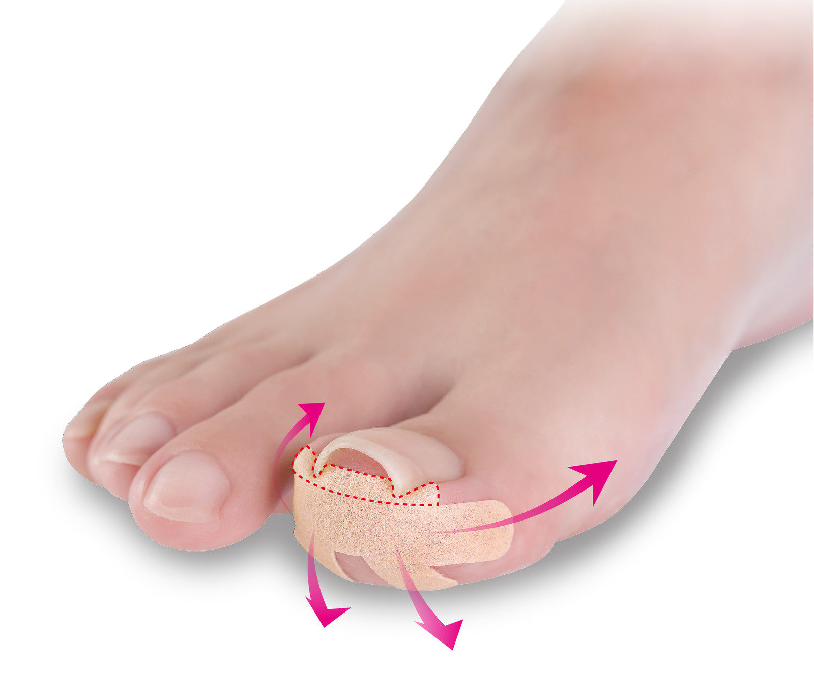 日本制甲沟矫正器指甲矫正贴嵌甲贴片脚趾甲贴片防止指甲往肉里长