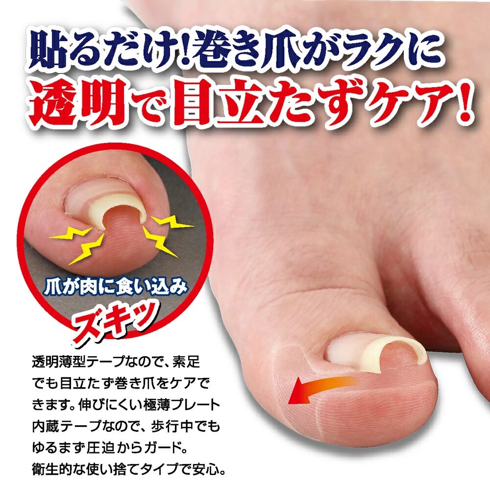 日本趾甲长肉里甲沟嵌甲矫正贴片