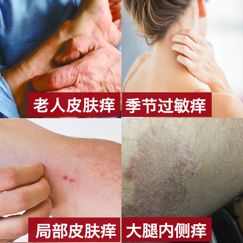 老人皮肤痒干燥起皮无激素成人神经皮焱草本痒止喷剂肤宁乐正品