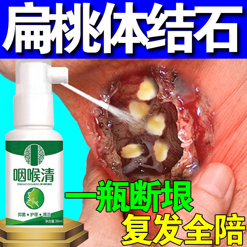 扁桃体结石去除工具隐窝冲洗器清理口腔喷雾漱口水咽喉吸引取口臭