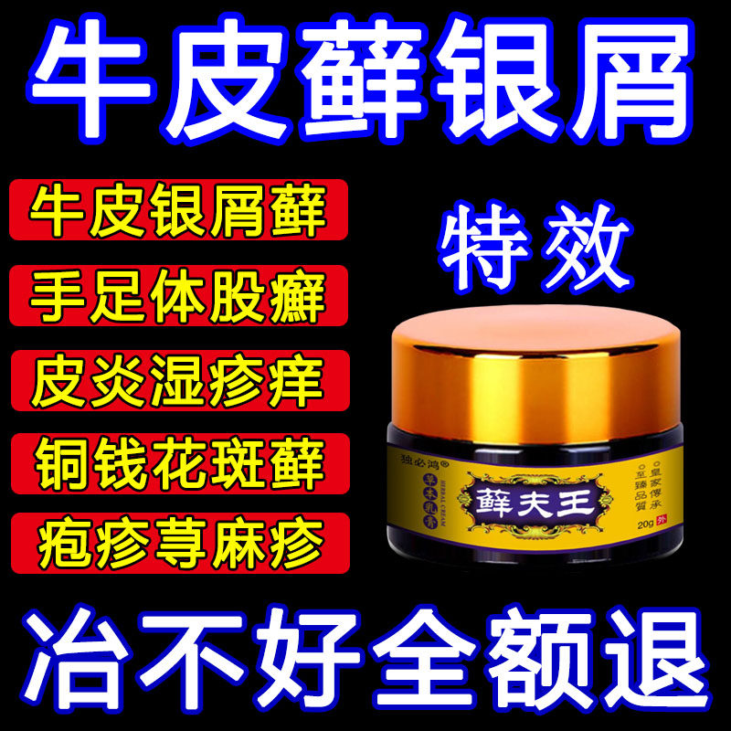 治疗牛皮癬鲜银屑病股藓手足头皮癣水泡皮炎湿疹止痒皮肤专用药膏