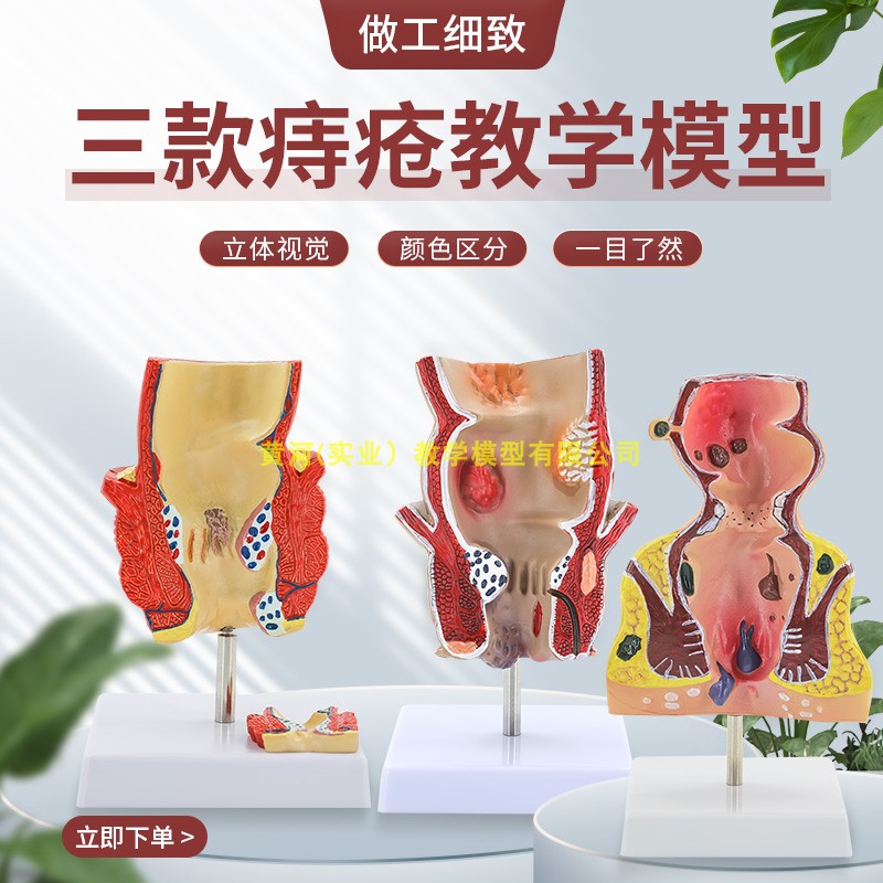 直肠病理人体模型黄和教学
