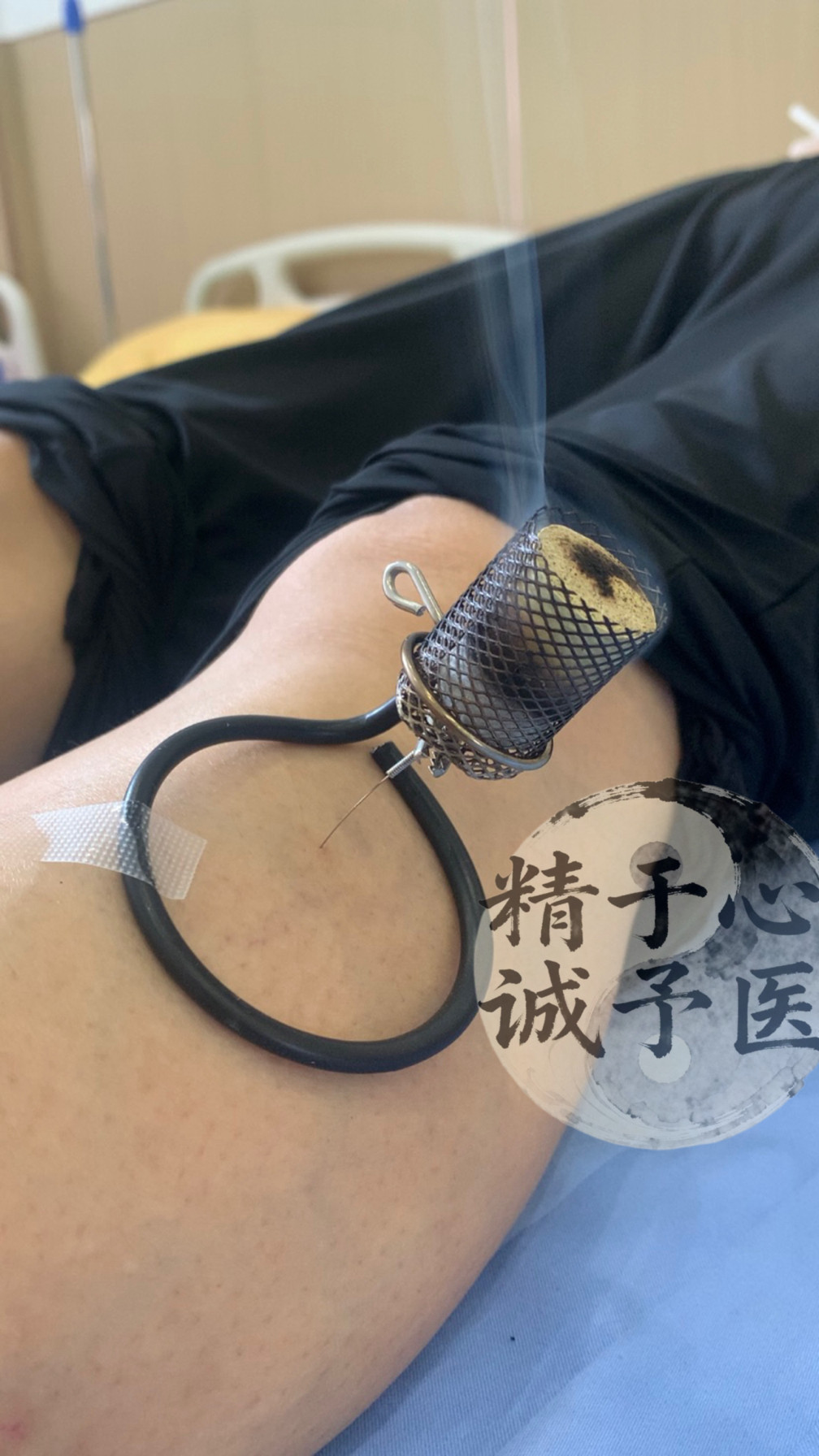 温针灸防落灰器，温针灸无烟艾灸器温针灸夹紧器温针灸防烫工具