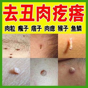 去刺瘊子皮赘去猴子脖子长小肉粒疙瘩肉瘤去除膏凸神器疣瘊偏方