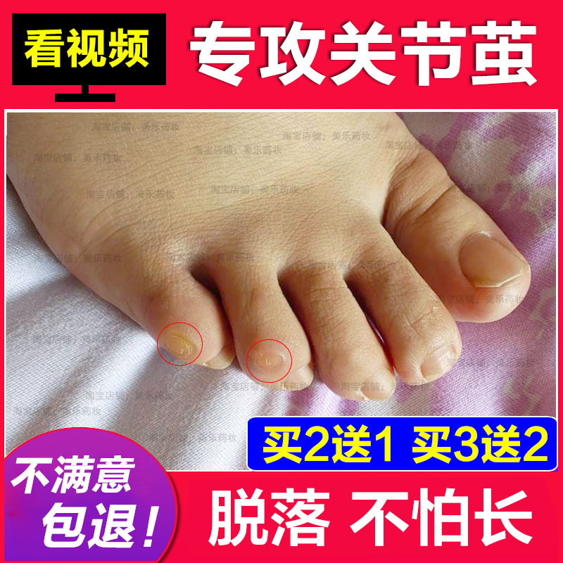 死皮关节足部软化剂脚垫茧子