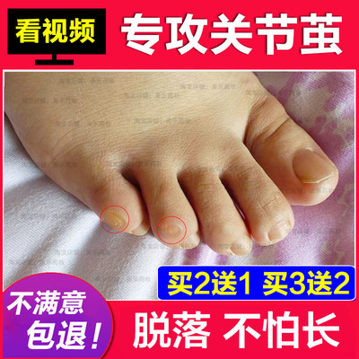 死皮关节足部软化剂脚垫茧子