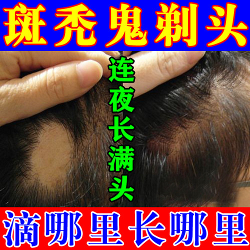 【一抹生发】100%治愈率，包生发