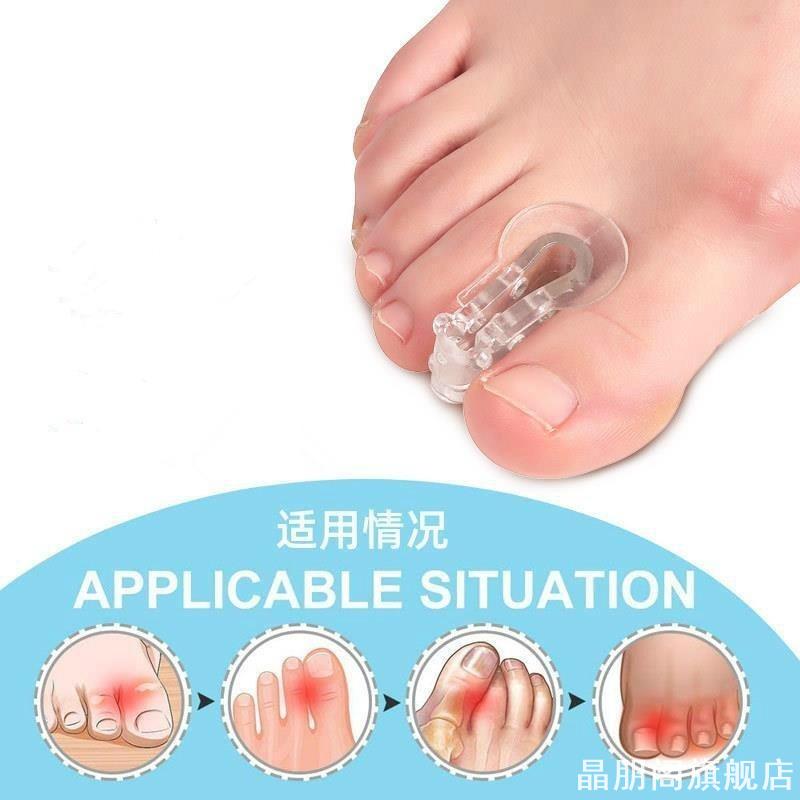 矫形器分离器矫正器脚趾头新款