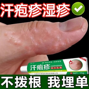 手上起小水泡汗泡疱止痒中药抑菌鹅掌风真菌感染手气湿痒疹专用膏