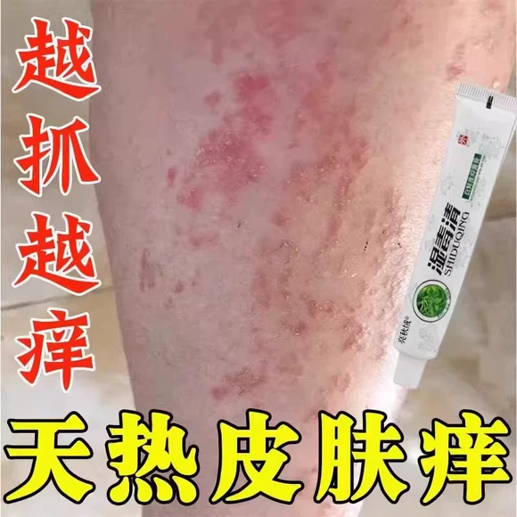 夏天小腿痒湿成人止膏出汗身上痒天热皮肤疹瘙痒热疙瘩红疹热毒痒