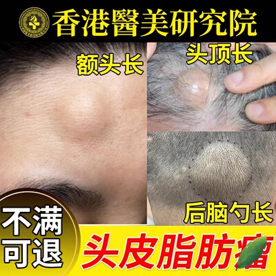 头上长硬疙瘩皮下脂肪神专用器消瘤膏硬块后脑勺额头鼓包去B6