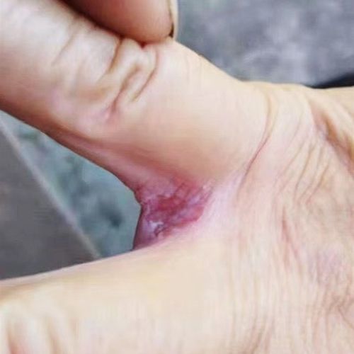 现货速发手指缝溃烂手丫手指烂手丫药膏溃烂手指发红脱皮手丫烂杀
