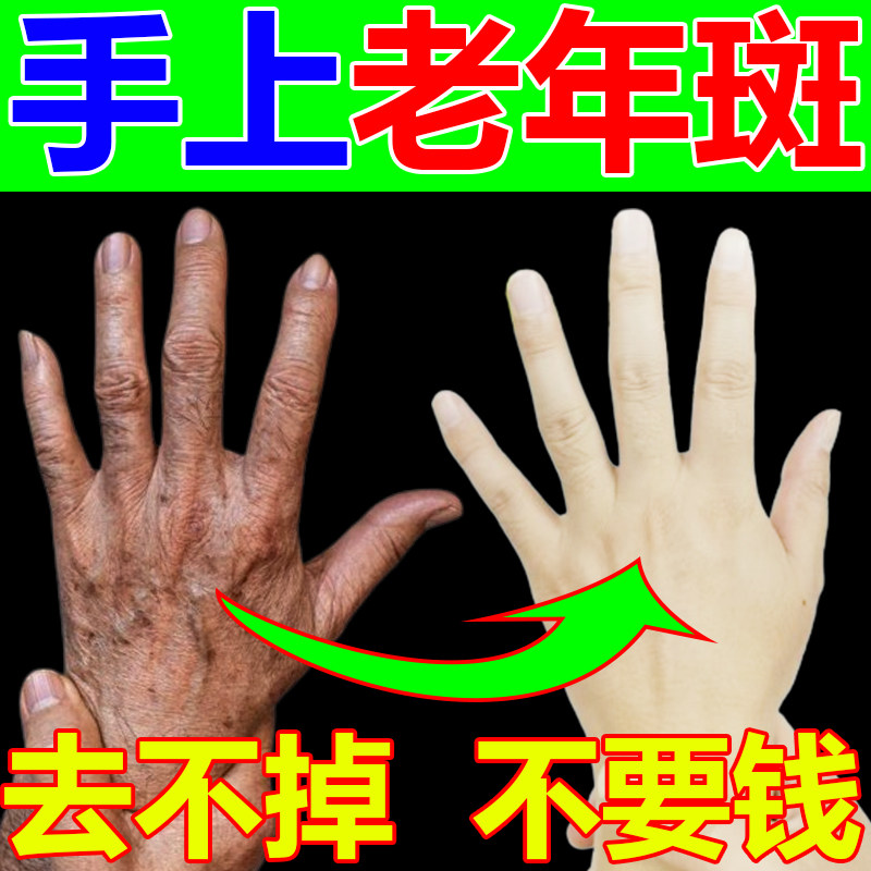 手上老年斑强力去除手部祛斑手背晒黑斑黄褐斑黑色素沉淀淡斑美白