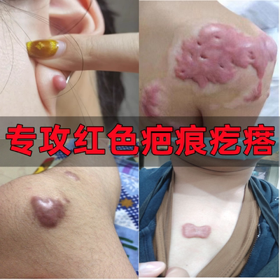 去除疤痕增生凸起胸前瘢痕疙瘩膏
