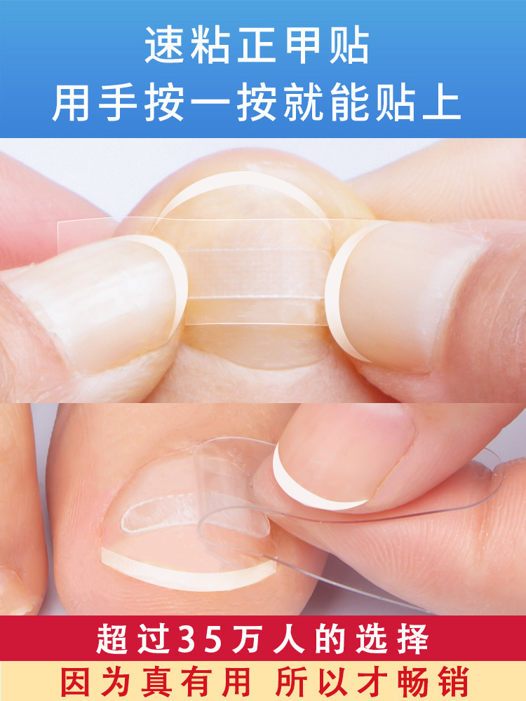 손톱 홈 교정 패치 내생발톱 패치 손톱 버클 발톱 패치 긴살 인공물 손톱 컬 염증 복구 및 교정