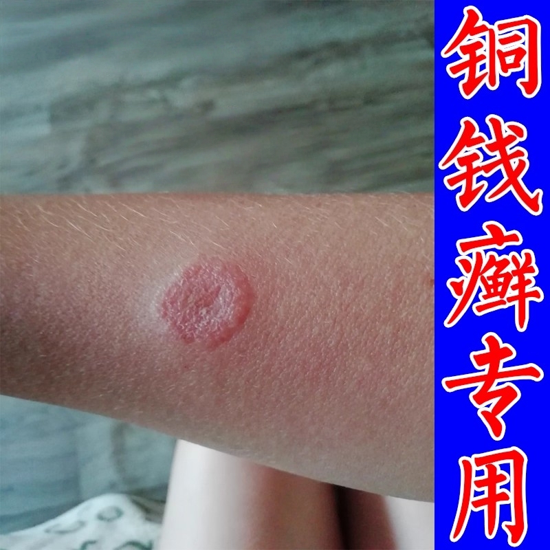 铜钱癣体癣专用药膏皮肤真菌感染