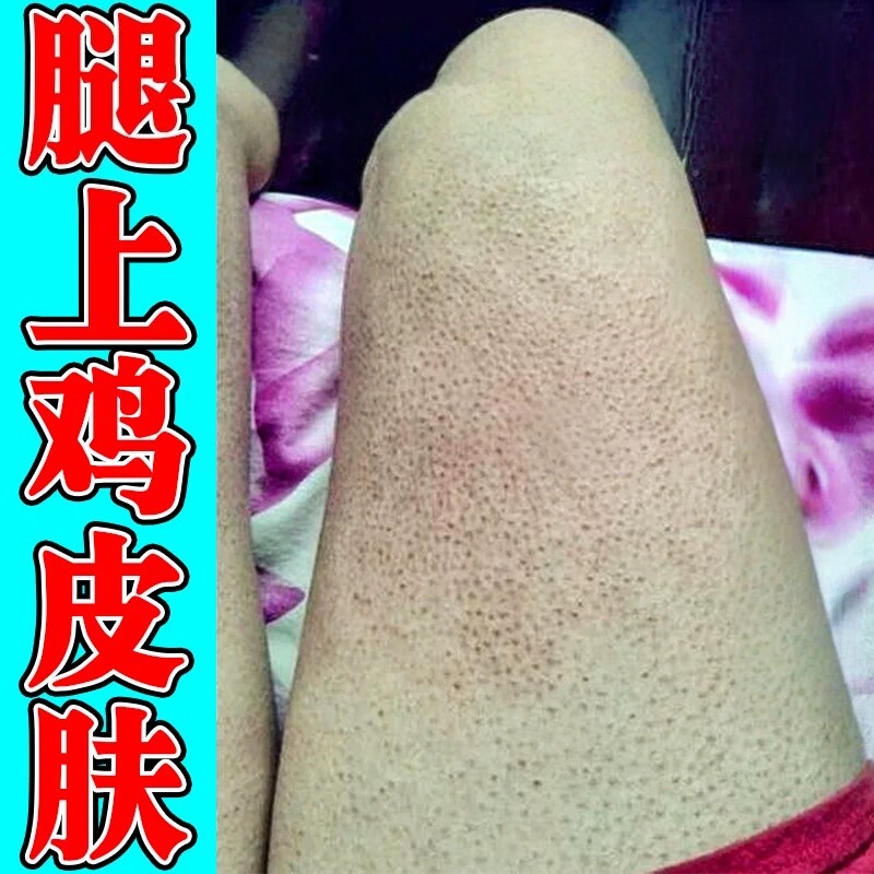 鸡皮肤疙瘩毛囊角化症专用药膏神器去除全身腿上小颗粒粗糙身体乳