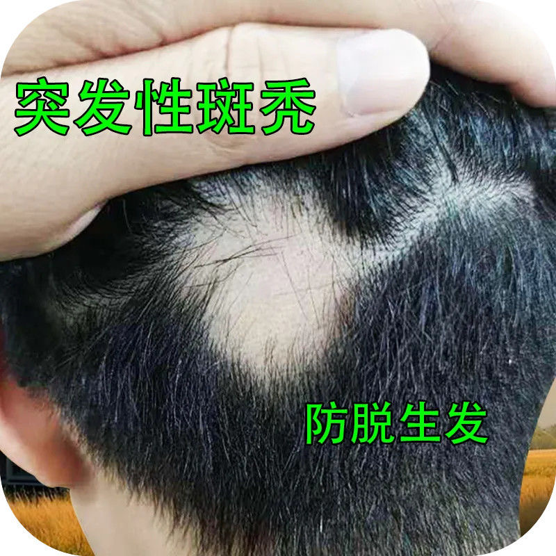 斑秃特效鬼剃头药防脱发克星专用生发液一抹灵生姜生发液遮盖神器