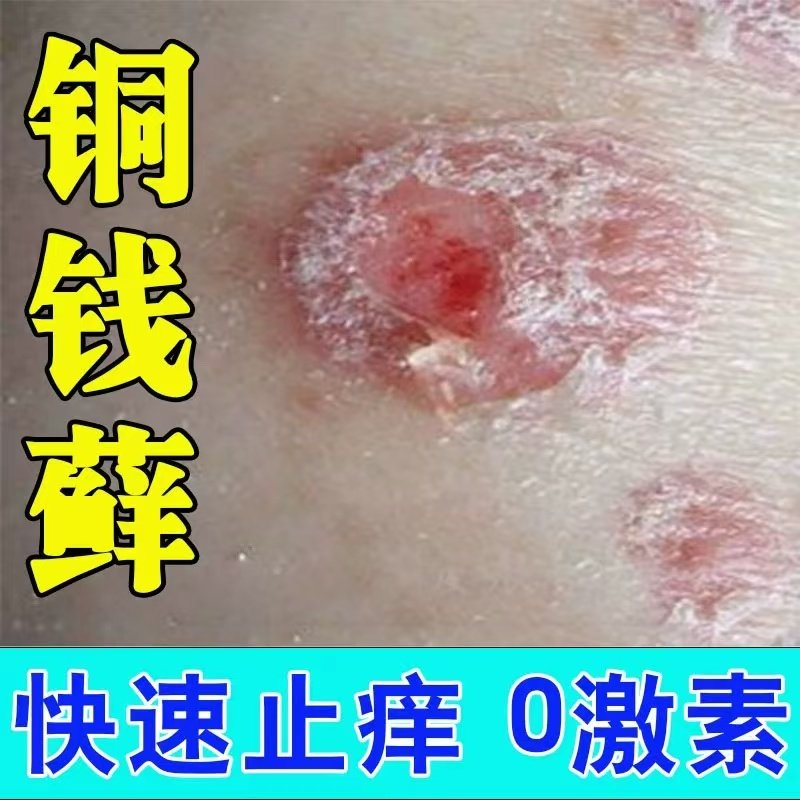铜钱藓皮肤瘙痒长红斑抑菌止痒膏