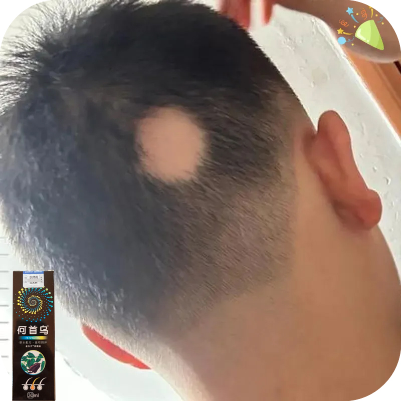 鬼剃头后脑勺小块秃掉发毛囊受损修复头发再生斑秃生发剂秃头克星