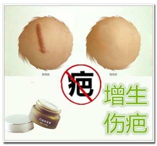修复男女士脸部黑色素沉着的药膏去除烧烫伤疤痕灵增生性体质正品