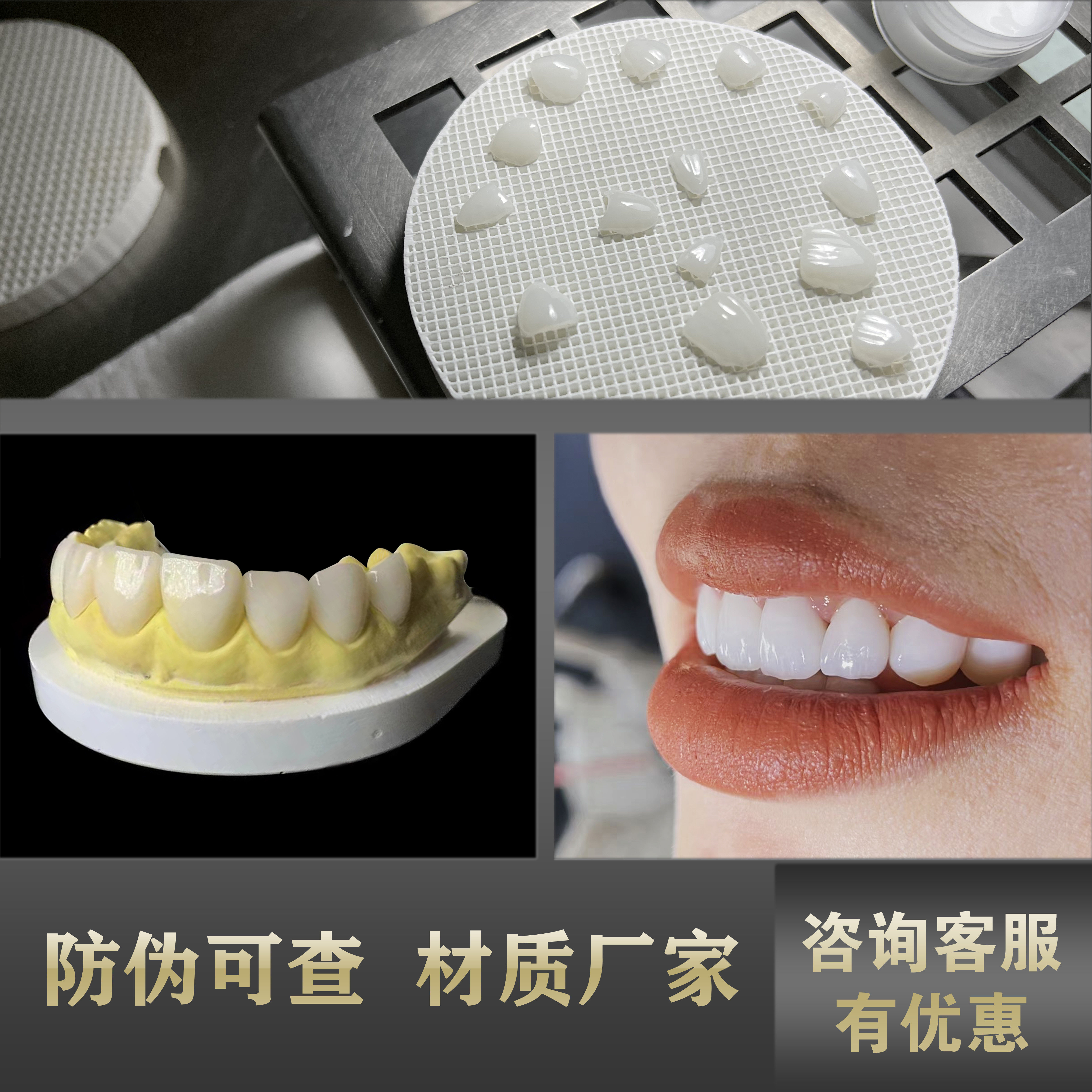 义获嘉全瓷贴面 陶瓷贴片蓝瓷牙贴面牙贴片牙齿贴片正品