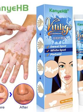 20g Herbal Extract Vitiligo Ointment Remove Ringworm White S