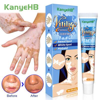 20g Herbal Extract Vitiligo Ointment Remove Ringworm White S