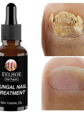 30ml Fungal Nail Repair Essence Feet CareTreatment Foot Toe