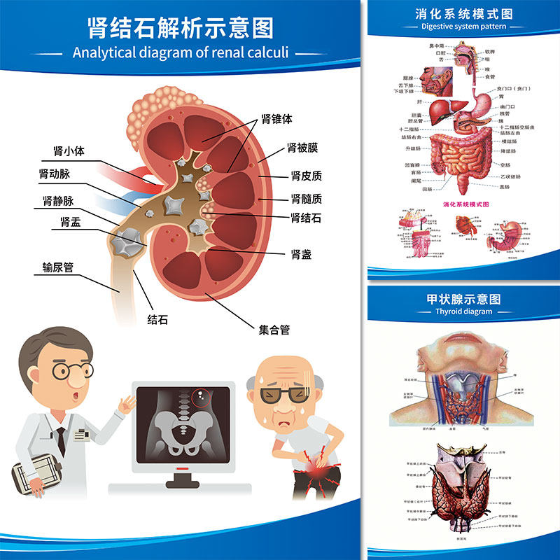 肾结石泌尿解剖图医学宣传挂图人体器官结构图医院海报墙贴纸挂图