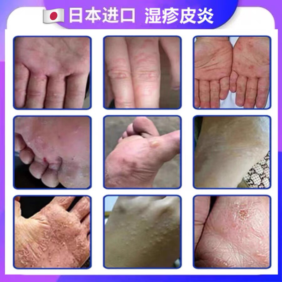 日本进口老牌止痒抑菌乳膏皮肤瘙痒皮炎强力全身痒皮肤病外用软膏