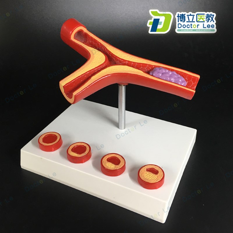 血管堵4塞 血液浓度脂肪 病理z血液 血管粥样血管病理解剖 模型