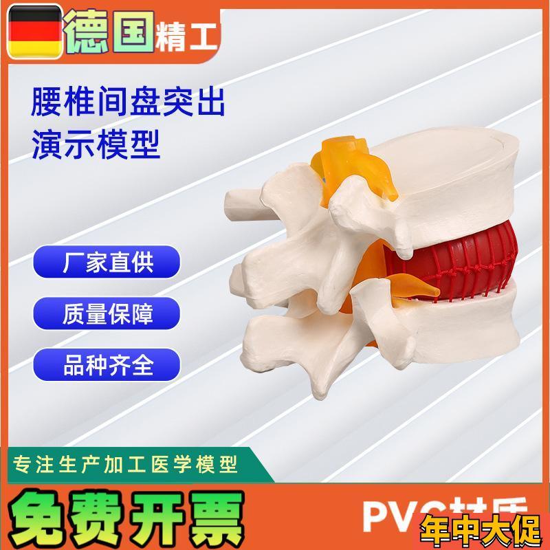 椎间盘模型人体腰椎突出病理演示模型11*10*7.6CM
