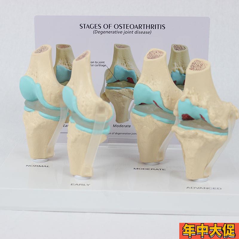 4阶段膝关节模型带背卡病变膝关节模型 骨科教学展示教具